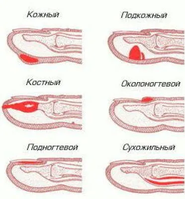 Панариций — Википедия