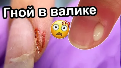 Панариций: симптомы, диагностика и лечение