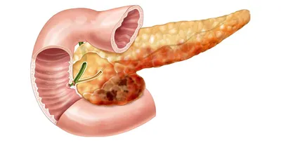 Панкреонекроз - причины, диагностика и лечение в лучших клиниках - MedTour