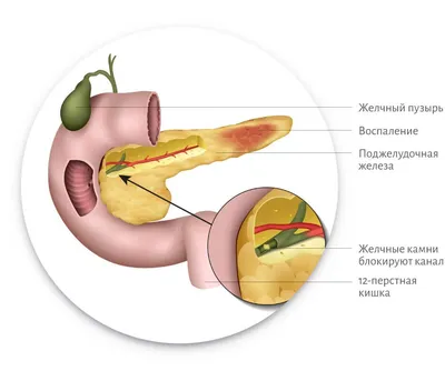 Острый панкреонекроз: симптомы, диагностика и эффективные методы лечения