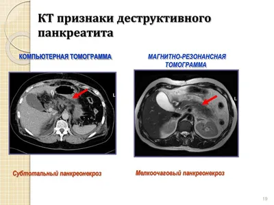 Острый панкреатит (панкреонекроз), часть 3. Лекция для студентов  медуниверситета. - YouTube