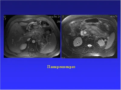 Сегодня ты - а завтра я\". Панкреонекроз. Лечение. Дренирование. ч.2. Первая  смерть. | Жизненно | Дзен