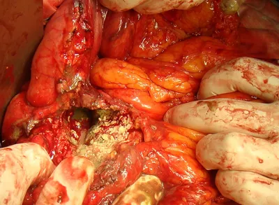 Хирургическое лечение осложнений панкреонекроза / Отделение абдоминальной  хирургии