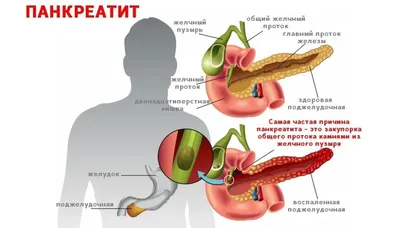 Рецидивирующий гнойный панкреонекроз. Особенности клиники, диагностики,  оперативного лечения – тема научной статьи по клинической медицине читайте  бесплатно текст научно-исследовательской работы в электронной библиотеке  КиберЛенинка