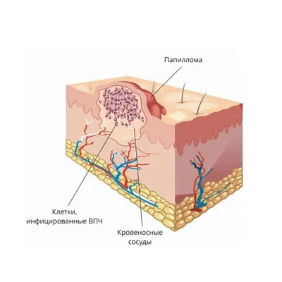 Папиллома родинка бородавка удаление клиника др. Шестаков