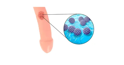 Венеролог высшей категории - Папилломы половых органов (остроконечные  кондиломы) ⠀ Причины появления папиллом половых органов (кондилом): ⠀ ￼✔️ Папилломы половых органов или остроконечные кондиломы – это конусообразные  наросты, которые появляются ...