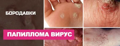 Не виноватый я! Он сам растёт!\"(c) Вирус папилломы человека | Пикабу