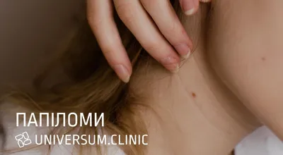 Как избавиться от папиллом | Блог Daily Medical