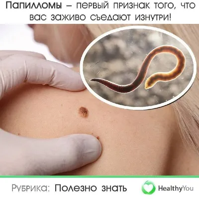 Папилломы – первый признак того, что вас заживо съедают изнутри! |  Health+Phone+Money+Book | Дзен