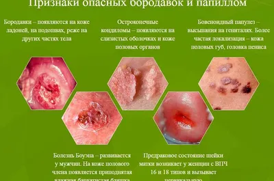 Лечение папилломы заднего прохода: комплексный подход к оздоровлению  организма