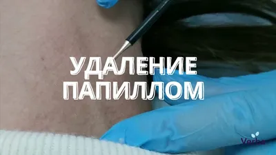 Папилломы возле заднего прохода фото