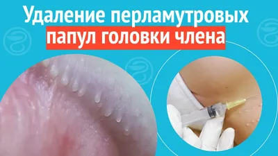 Дерматотропные средства Glenmark Клензит-С - «Средство которое спасло мою  кожу и мою психику» | отзывы