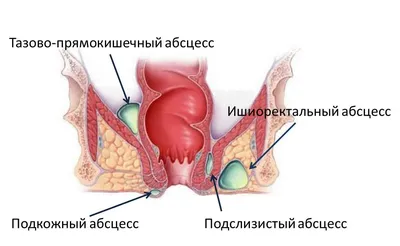 Парапроктит: причины, виды, симптомы. Методы лечения парапроктита