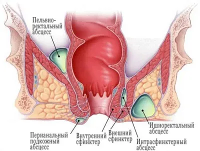 Острый парапроктит — симптомы, диагностика, лечение заболевания