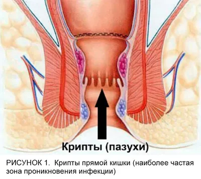 Парапроктит ⋮ Лечение парапроктита в Medical Plaza