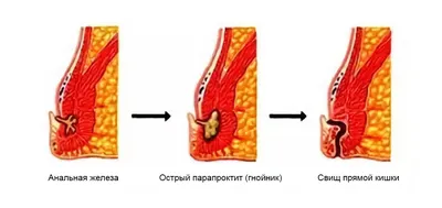 Острый парапроктит - Медицинский центр «На Восточной»