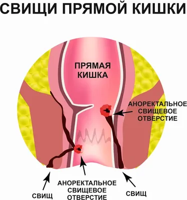 Ультразвуковая диагностика хронического парапроктита. | Тамбовская  областная клиническая больница имени В.Д. Бабенко