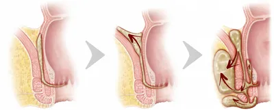 Свищ прямой кишки (параректальный свищ): причины, симптомы, виды,  осложнения, лечение, профилактика