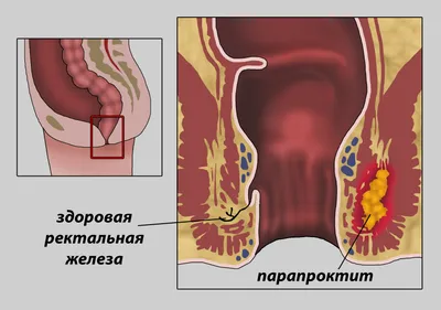 Парапроктит лечат в Онли Клиник