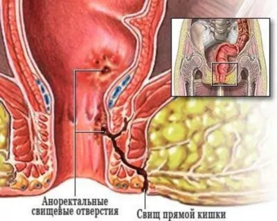 Парапроктит операция - цена хирургического лечения в Ужгороде, Украина |  Клиника Биляка