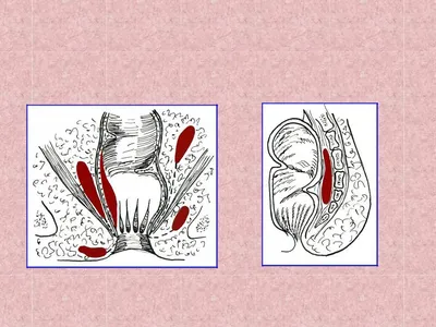 Парапроктит | Медицинский центр «Оливия»