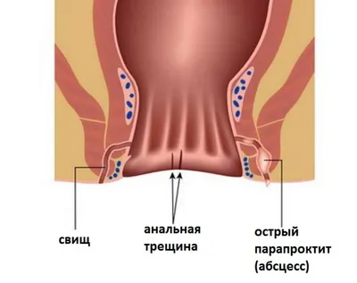 Лечение парапроктита в Одессе. Парапроктит: классификация, симптомы,  осложнения, лечение | Медицинский дом Odrex