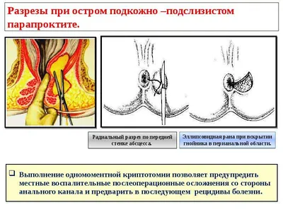 Лечение парапроктита