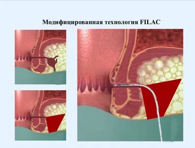 Лечение сложного рецидивирующего парапроктита с пельвиоректальным и  ретроректальным затеком - история лечения в Ильинской больнице.