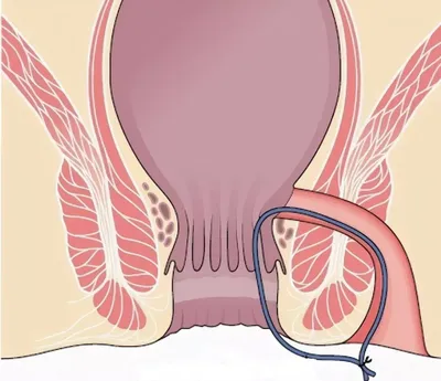 Парапроктит: симптомы, причины, виды, методы лечения в «Президент-Мед»