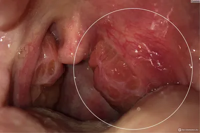 Вскрытие паратонзиллярного абсцесса - «НЕ ДЛЯ СЛАБОНЕРВНЫХ. Вскрытие  паратонзиллярного абсцесса в Москве с фото» | отзывы