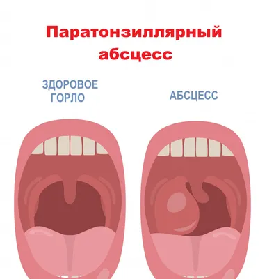 Паратонзиллярный абсцесс вскрытие фото