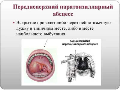 Воспалительные заболевания верхних путей. Где поджидает опасность? |  Ординаторская.онлайн | Ординаторская онлайн