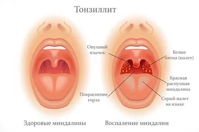 Лечение тонзиллита в Москве лазером - цена от 2500 руб