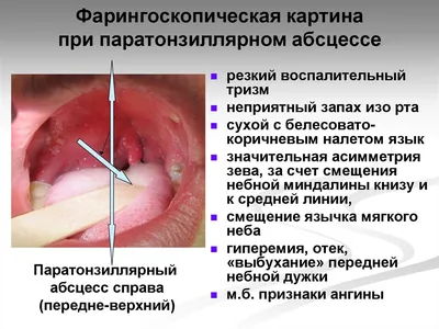 Вскрытие тубоовариального абсцесса