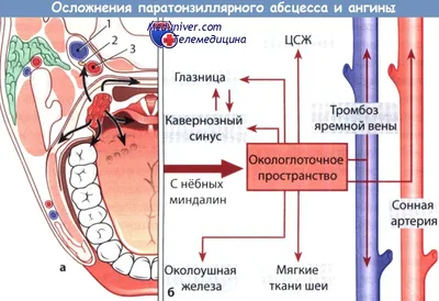 Вскрытие паратонзиллярных абсцессов у детей