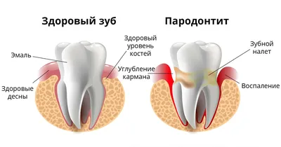 Пародонтит фото