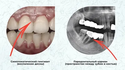 Что такое пародонтит? Признаки, причины, диагностика и лечение пародонтита