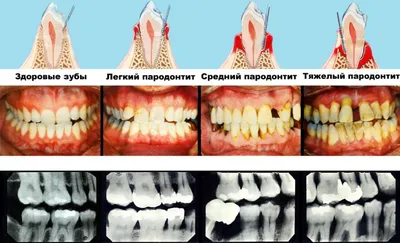 Пародонтит: симптомы, причины, диагностика, профилактика и лечение  заболевания полости рта современными методами