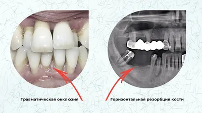 Пародонтит касается не только десен, но и корня и связок зуба - Альянс  бьюти-стоматологов, Москва