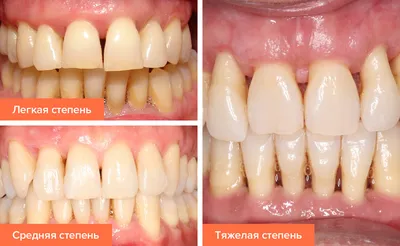 Консервативное лечение пародонта