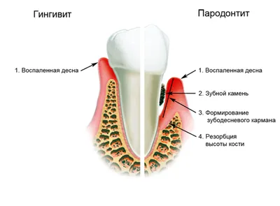 Пародонтит — признаки, причины, классификация, степени тяжести в статье на  Startsmile.ru