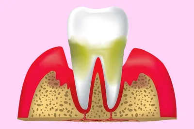 Хронический пародонтит легкой, средней и тяжелой степени — методы лечения в  статье Startsmile