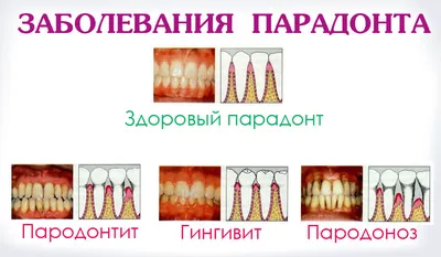 Пародонтоз и пародонтит. Различия, причины, меры профилактики и лечения