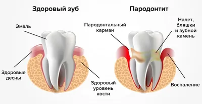 ᐈ Пародонтит: симптомы и лечение фото, что это такое