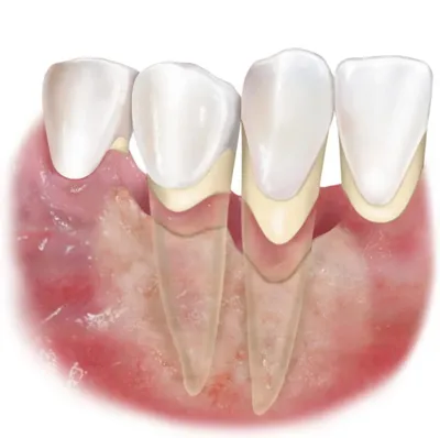 Хронический пародонтит легкой, средней и тяжелой степени — методы лечения в  статье Startsmile
