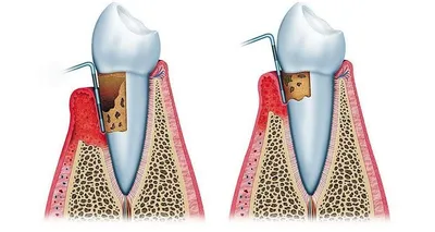 Пародонтит и особенности его лечения
