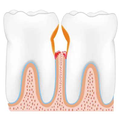 Уход за зубной полостью рта при заболеваниях: пародонтоз и пародонтит |  средства для лечения от ЗДОРОВ74.РФ | ЗДОРОВ74.РФ | Дзен