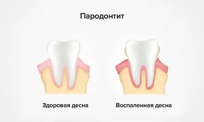 Пародонтит — симптомы и лечение, причины заболевания | Статьи «Клиника  вашего стоматолога»