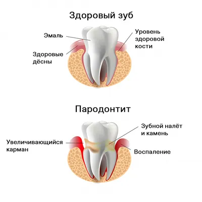 Пародонтит