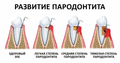 Пародонтит: диагностика и лечение в Харькове